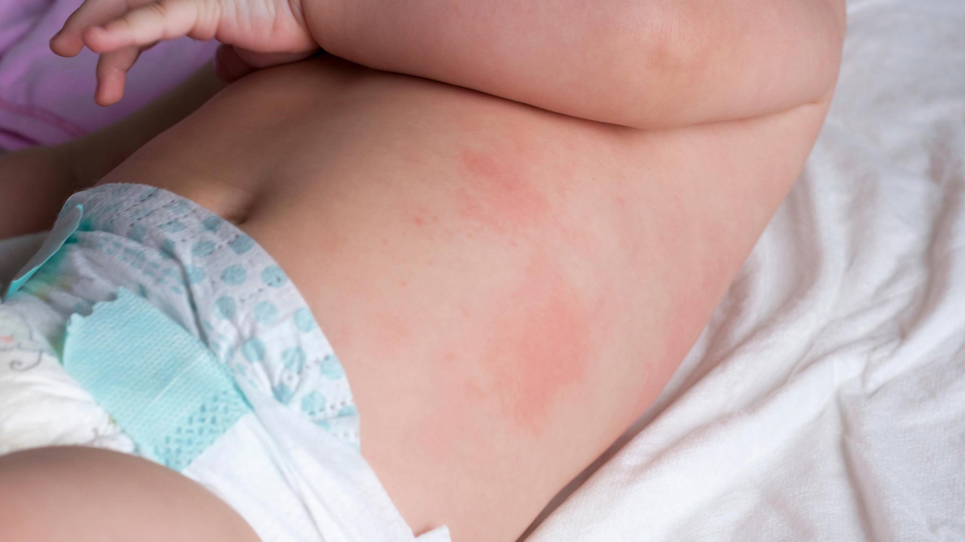 Dziecko w pieluszce lezy na poscieli z wysypka